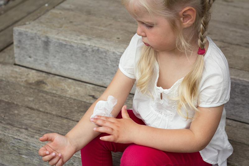 Burns and Scalds in Children: Immediate First Aid and When to Get Medical Help